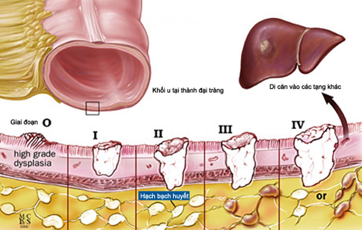 Điều trị ung thư đại tràng giai đoạn 1