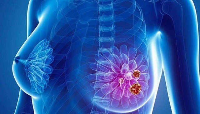 Điều trị phẫu thuật trong ung thư vú