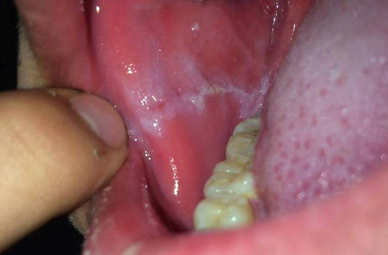Viêm nhiễm miệng: Nguyên nhân, triệu chứng, chẩn đoán và điều trị