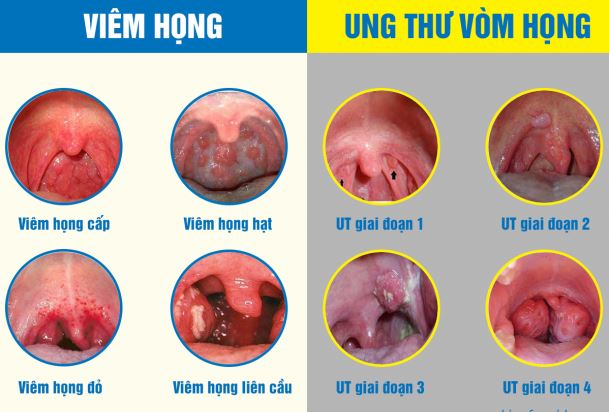 Phân biệt ung thư vòm họng và viêm họng thông thường