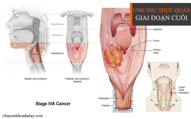 Bị ung thư thực quản sống được bao lâu?