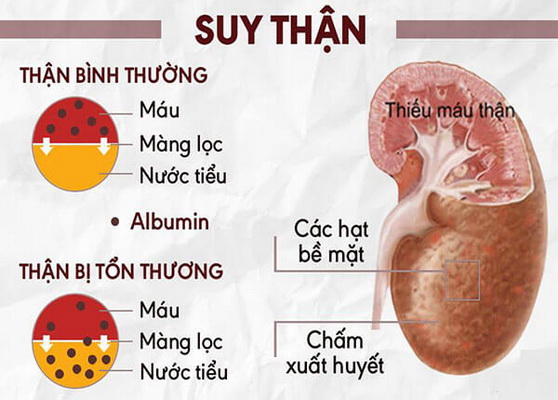 Cảnh giác suy thận cấp do ung thư