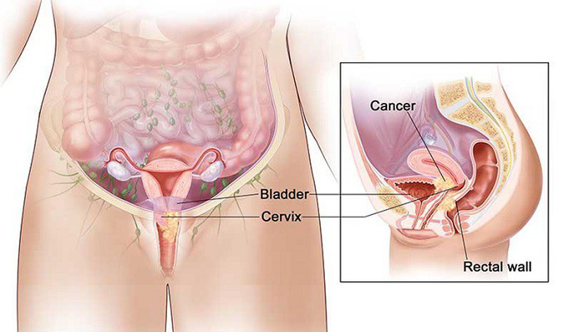 Ung thư cổ tử cung có thể chữa khỏi được không?