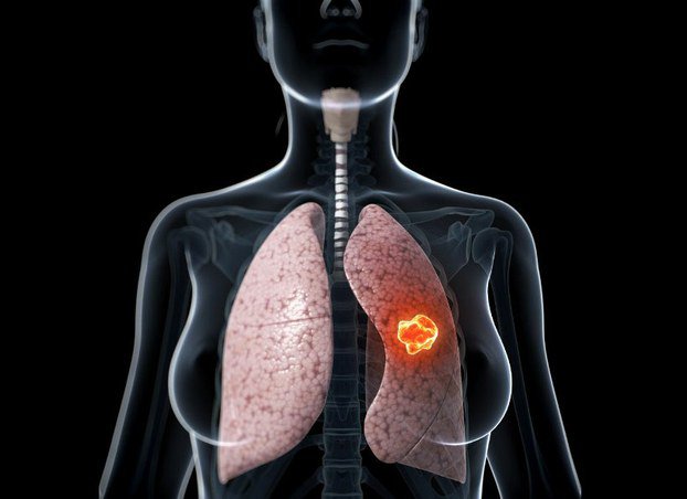 Ung thư phổi: Những điều bạn nên biết