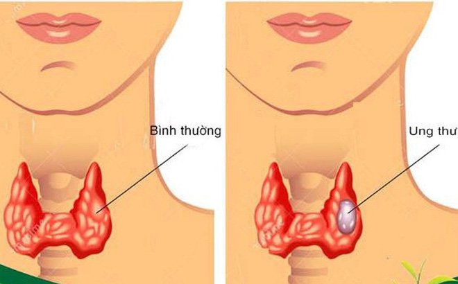 Cách tiếp cận và các phương pháp điều trị ung thư tuyến giáp (Phần 2)