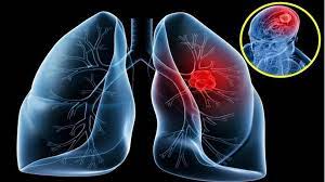 Tìm hiểu triệu chứng ung thư phổi thường gặp