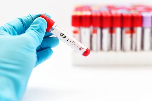 Các chỉ số xét nghiệm định lượng CEA trong máu