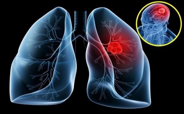 Bệnh ung thư phổi có lây không?