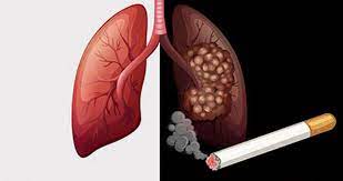 Hút thuốc lá gây ung thư phổi như thế nào?