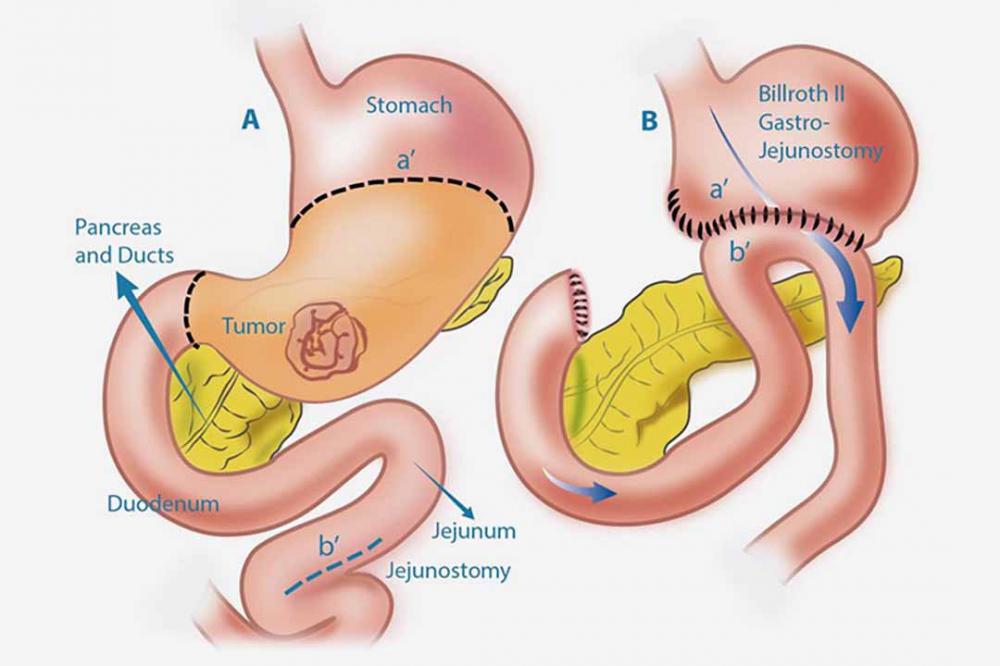 Phương pháp điều trị ung thư dạ dày