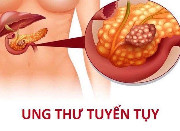 Cập nhật chiến lược phân loại và điều trị ung thư biểu mô tuyến ống tụy