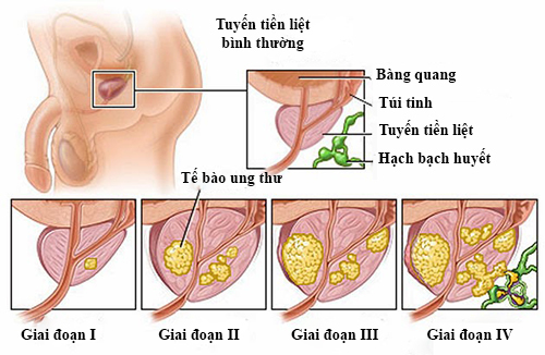 Các phương pháp điều trị ung thư tiền liệt tuyến