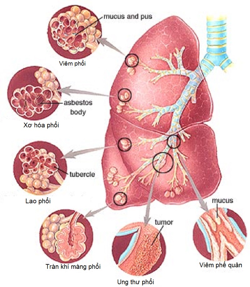Các loại suy hô hấp thường gặp