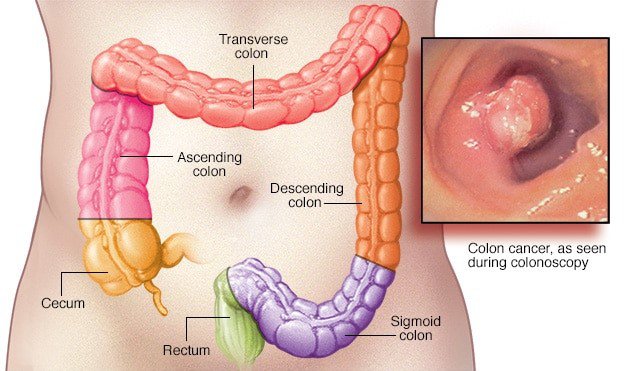 Bạn có thể làm gì để tăng thời gian sống sau điều trị ung thư đại trực tràng?