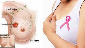 Các yếu tố làm thay đổi nguy cơ mắc ung thư vú ở phụ nữ