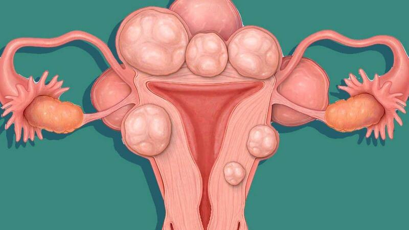 U xơ tử cung có nguy cơ chuyển thành ung thư không?