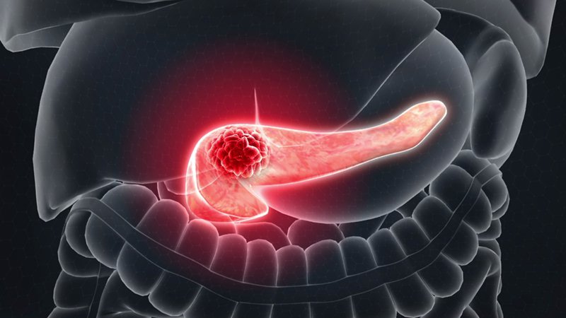 Sinh bệnh học của protein thụ thể RON trong ung thư gan mật và ung thư tụy