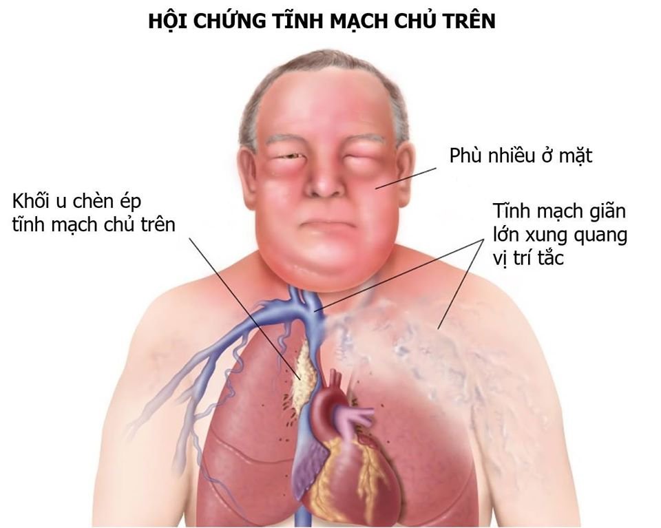 Bị chèn ép tĩnh mạch chủ trên do ung thư