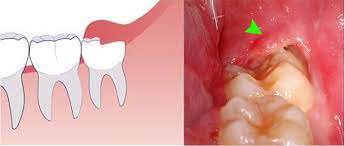 Lở loét miệng do điều trị ung thư: Cách đối phó