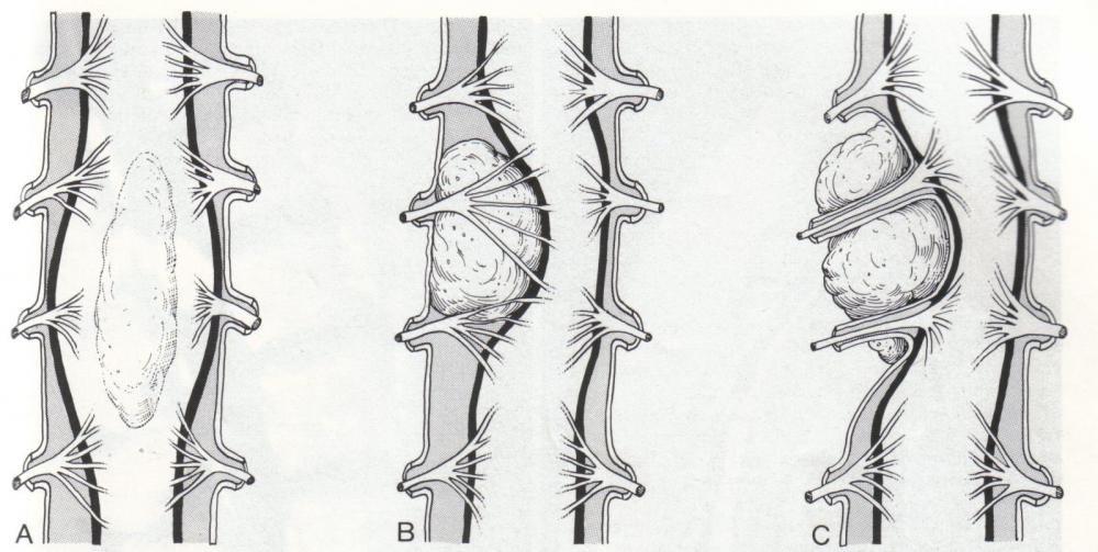 Các khối u tủy sống