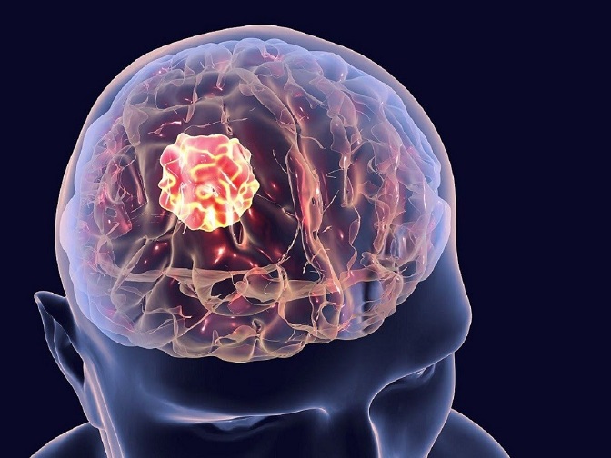 Ung thư não: Nguyên nhân, triệu chứng, chẩn đoán và điều trị