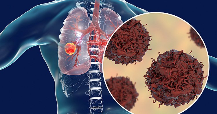 Ung thư phổi giai đoạn 4 điều gì sẽ xảy ra