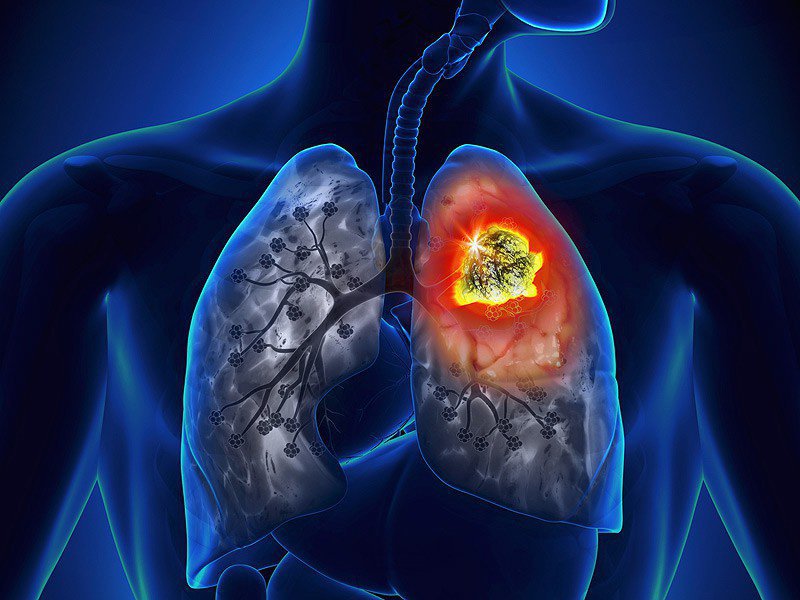 Tổng quan về nguyên nhân gây ung thư phổi