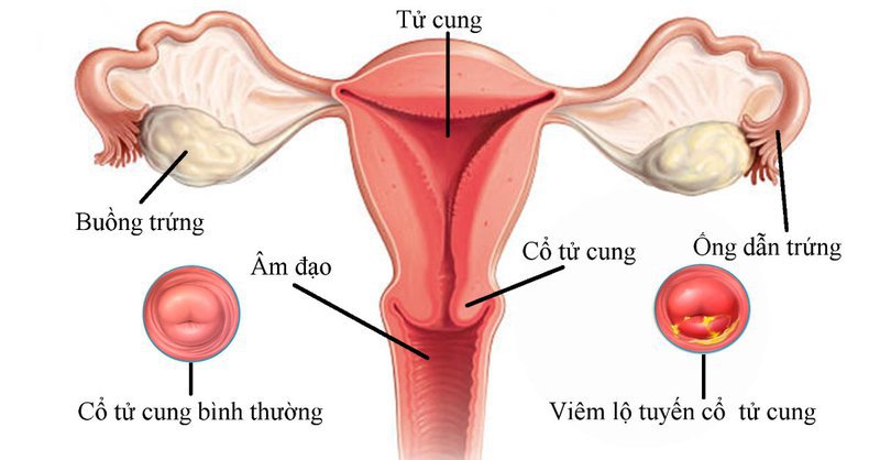 Hướng dẫn trực quan về ung thư cổ tử cung