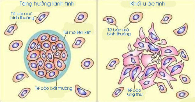 Các biểu hiện của khối u ác tính