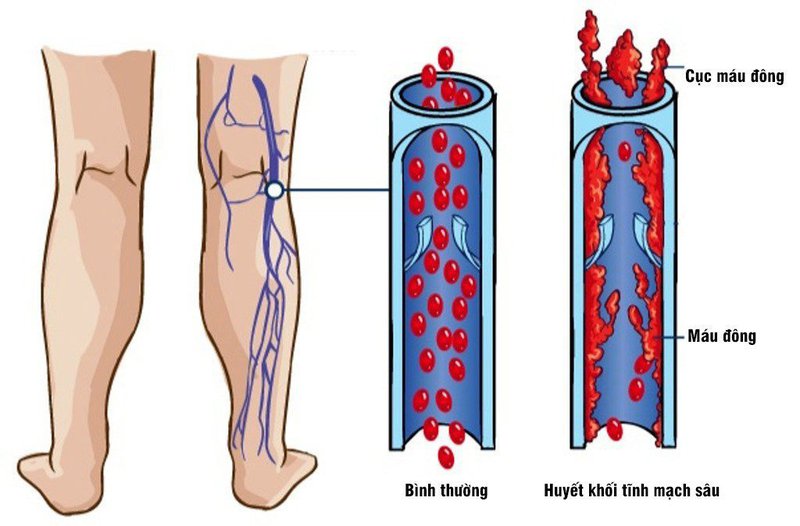 Dự phòng huyết khối tĩnh mạch sâu ở bệnh nhân ung thư