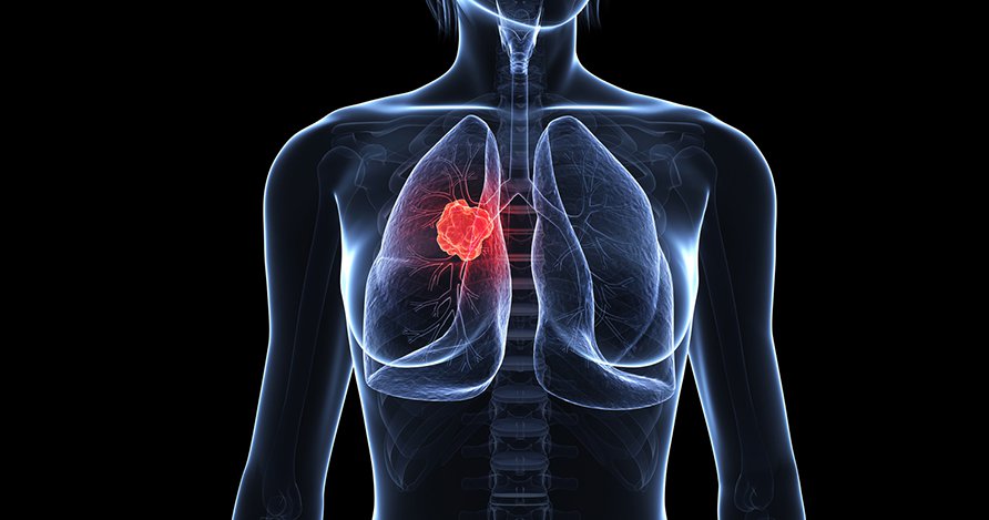 Tổng quan về đột biến gen trong ung thư phổi