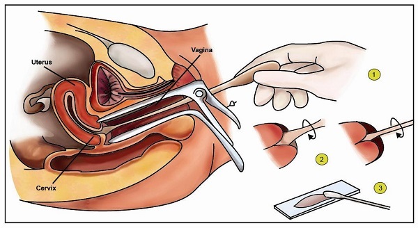 Điều trị ung thư cổ tử cung