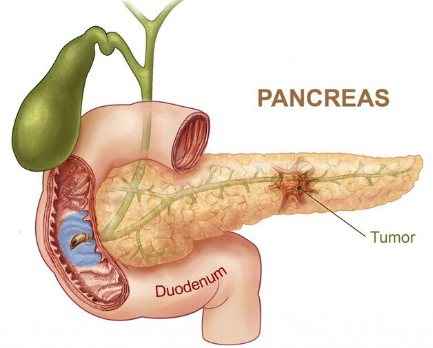 Điều trị ung thư gan mật tụy với mục tiêu là protein thụ thể RON