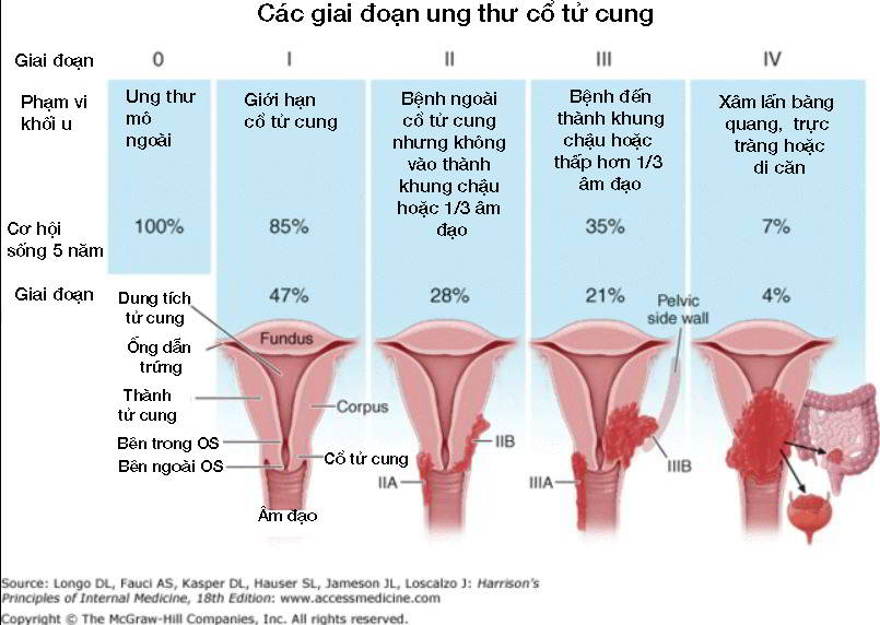 Điều trị ung thư nội mạc tử cung theo giai đoạn