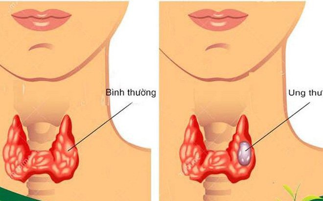 Chăm sóc và dinh dưỡng cho người bị ung thư amidan