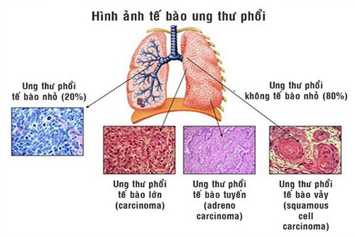 Các loại phẫu thuật cho bệnh ung thư phổi