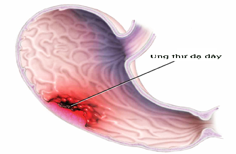 Những tiến bộ hiện nay của chẩn đoán ung thư dạ dày sớm