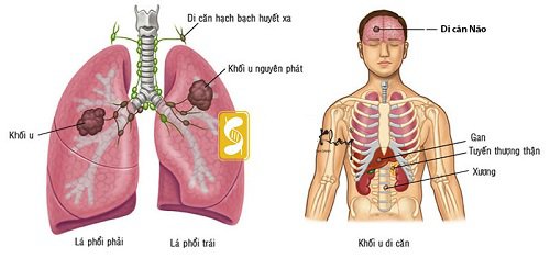 Bệnh nhân ung thư phổi sống được bao lâu?