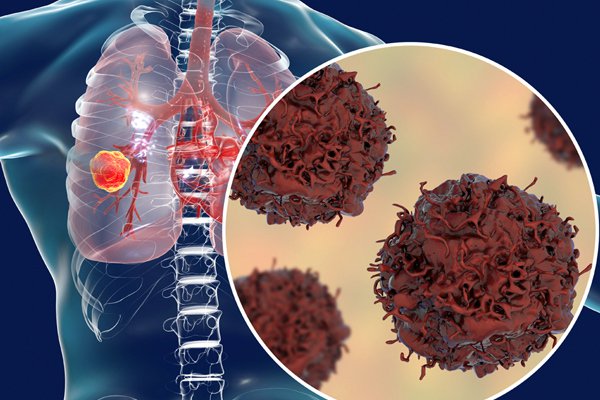 Ung thư phổi: Các yếu tố nguy cơ và cách phòng ngừa