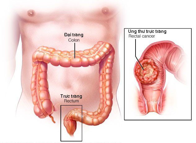 Cập nhật về phát hiện và phân loại ung thư đại tràng sớm