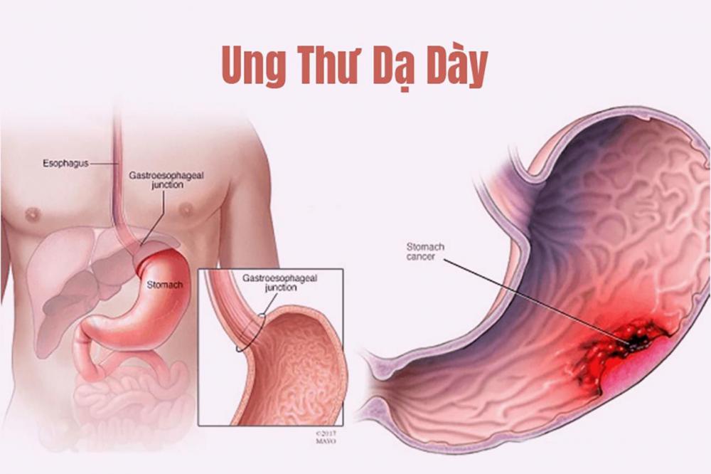 Chăm sóc sau điều trị ung thư dạ dày