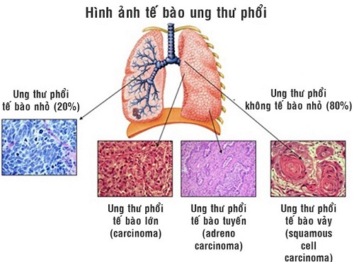 Chẩn đoán các giai đoạn của ung thư phổi