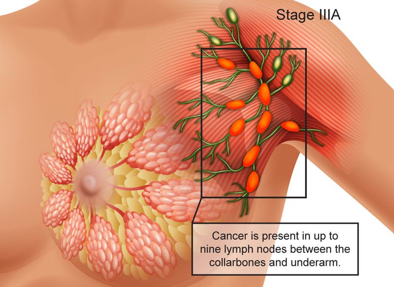 Sinh thiết hạch cửa trong ung thư vú chỉ định ở trường hợp nào?