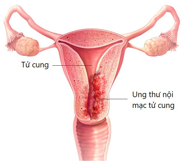 Ung thư nội mạc tử cung: Nguyên nhân, triệu chứng, chẩn đoán và điều trị