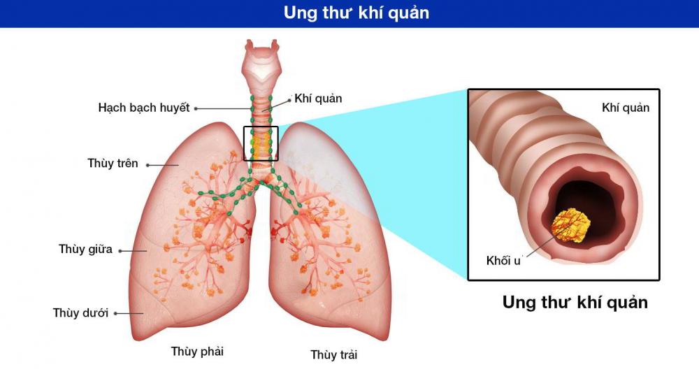 Khối u khí quản: Những điều cần biết