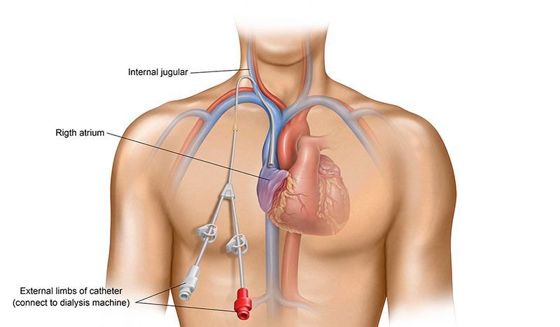Đặt ống thông tĩnh mạch trung tâm (catheter tĩnh mạch trung tâm)