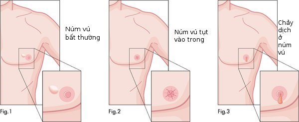 Nguyên nhân nào gây ung thư vú ở nam giới?