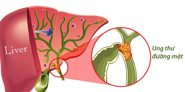 Ung thư đường mật (ống mật): Những điều cần biết