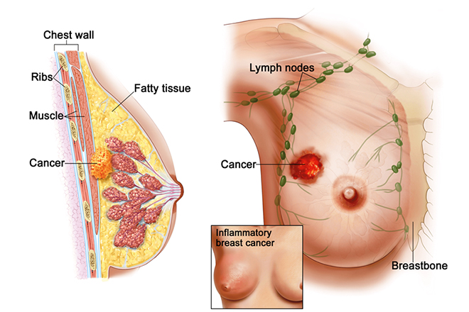 Điều trị ung thư vú giai đoạn 2