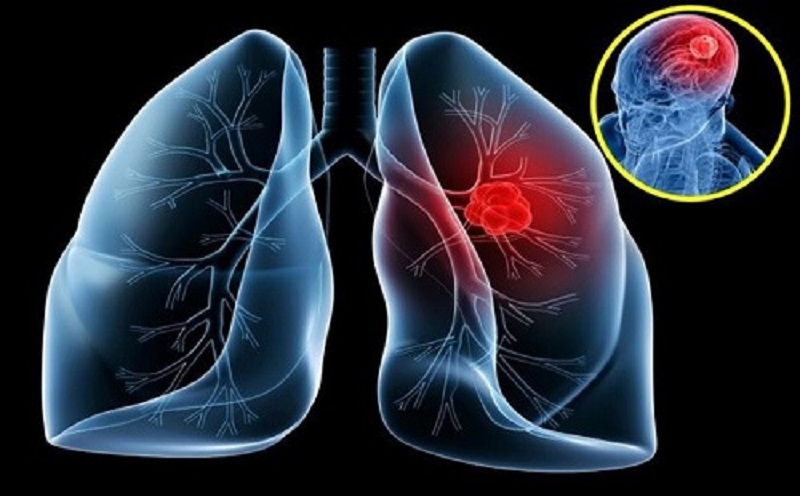Các xét nghiệm ung thư phổi